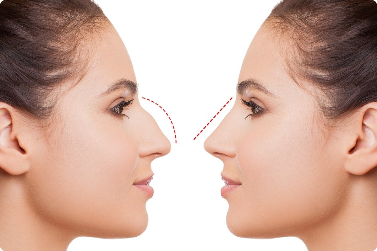 Top Benefits of Rhinoplasty in Dubai: Enhancing Both Aesthetics and Breathing