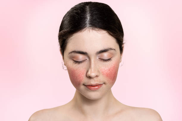  Say Goodbye to Rosacea: Effective Skincare Treatments Explained