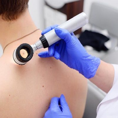  The Ultimate Solution for Skin Tags: Laser Skin Tag Removal in Dubai