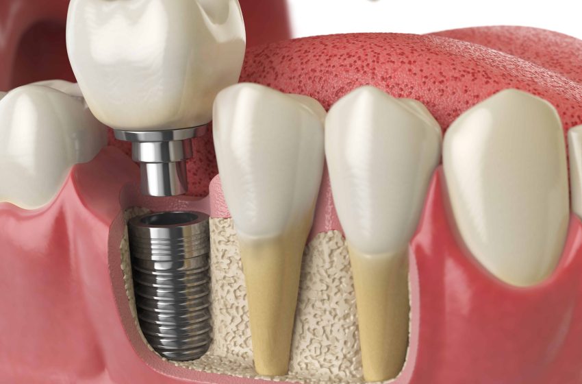  Are Dental Implants Right for You? Factors to Consider