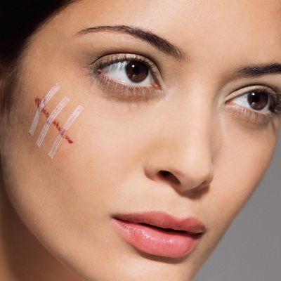  Surgical Scar Revision: Restoring Skin to Its Natural Beauty