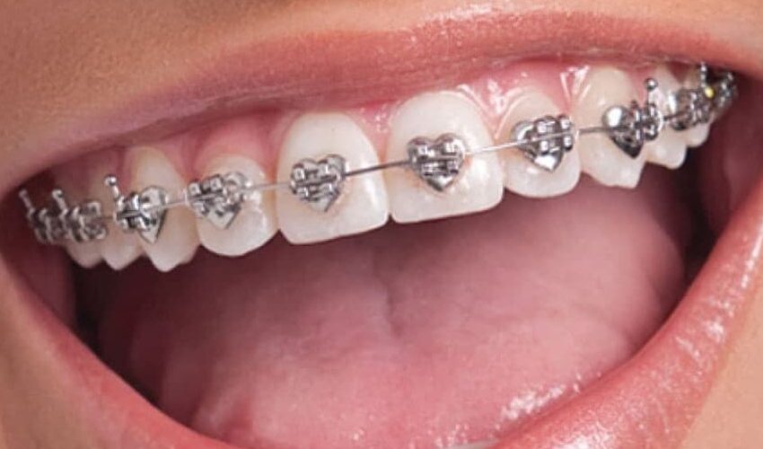  Innovations in Teeth Braces: What’s New in Orthodontics?