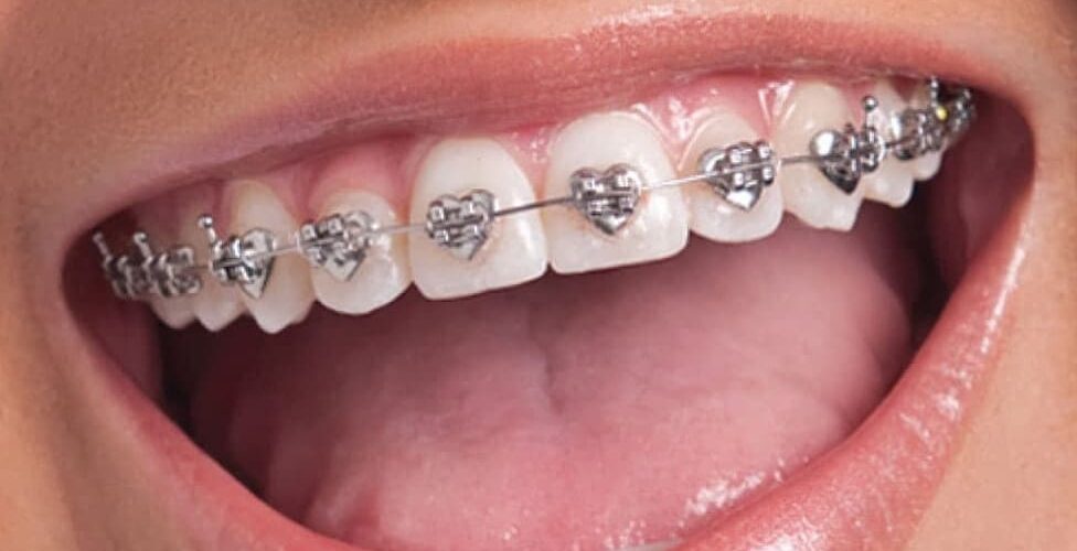 Innovations in Teeth Braces: What’s New in Orthodontics?