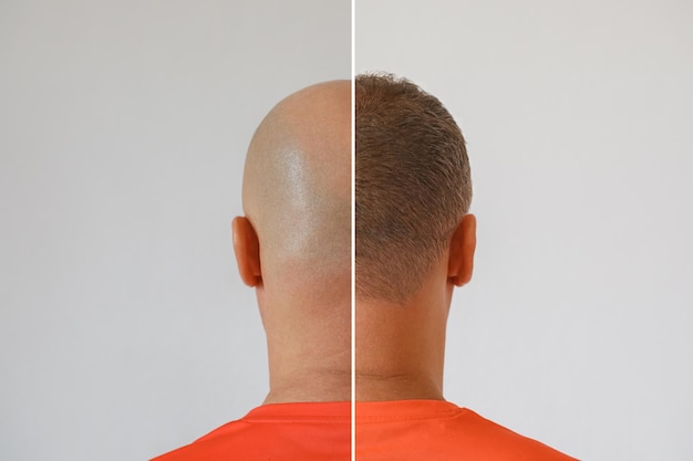  Tips for Finding the Best Hair Transplant Surgeon