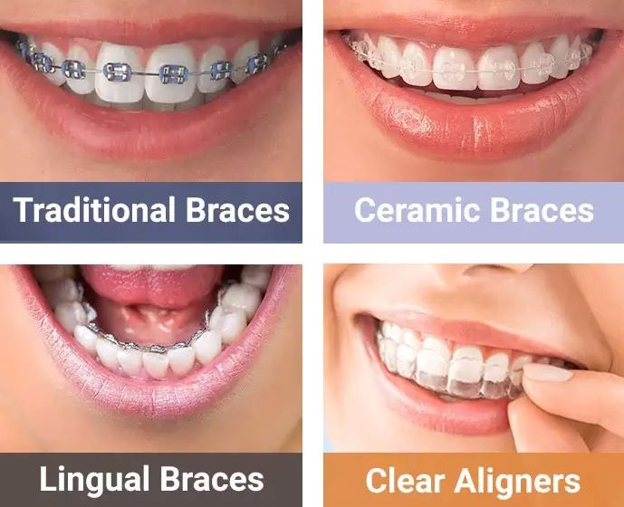  Explore the Different Types of Braces in Nampa ID for a Perfect Smile