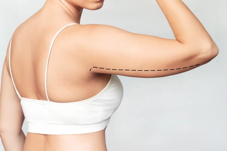  Underarm Liposuction: A Little Change for a Big Impact