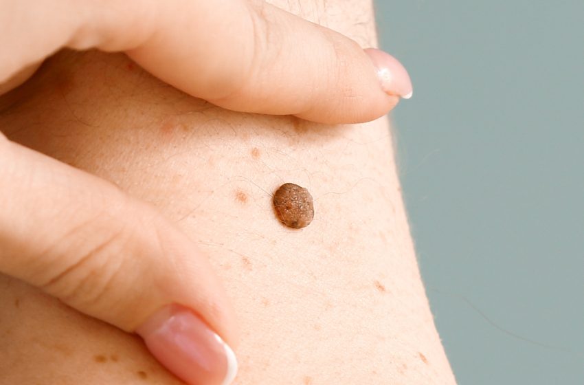  Mole Removal That Works: Say Hello to Blemish-Free Skin