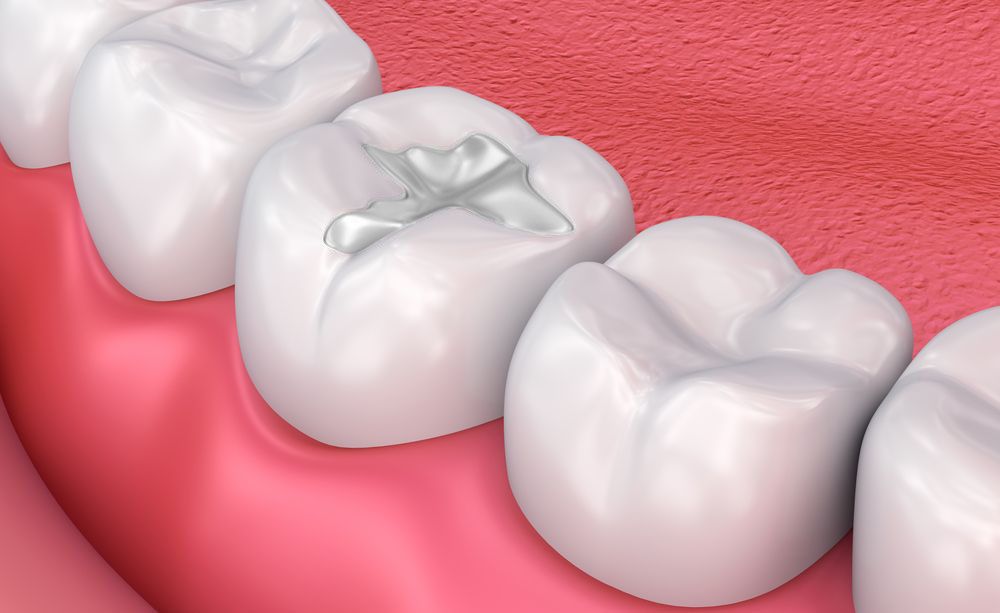 Why You Shouldn’t Wait for Restorative Dentistry in Nampa Idaho