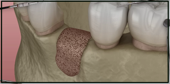  Innovations in Guided Bone Regeneration for Complex Dental Cases