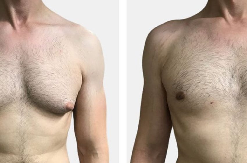  The Role of Ultrasound Technology in Reducing Scarring for Gynecomastia in Dubai