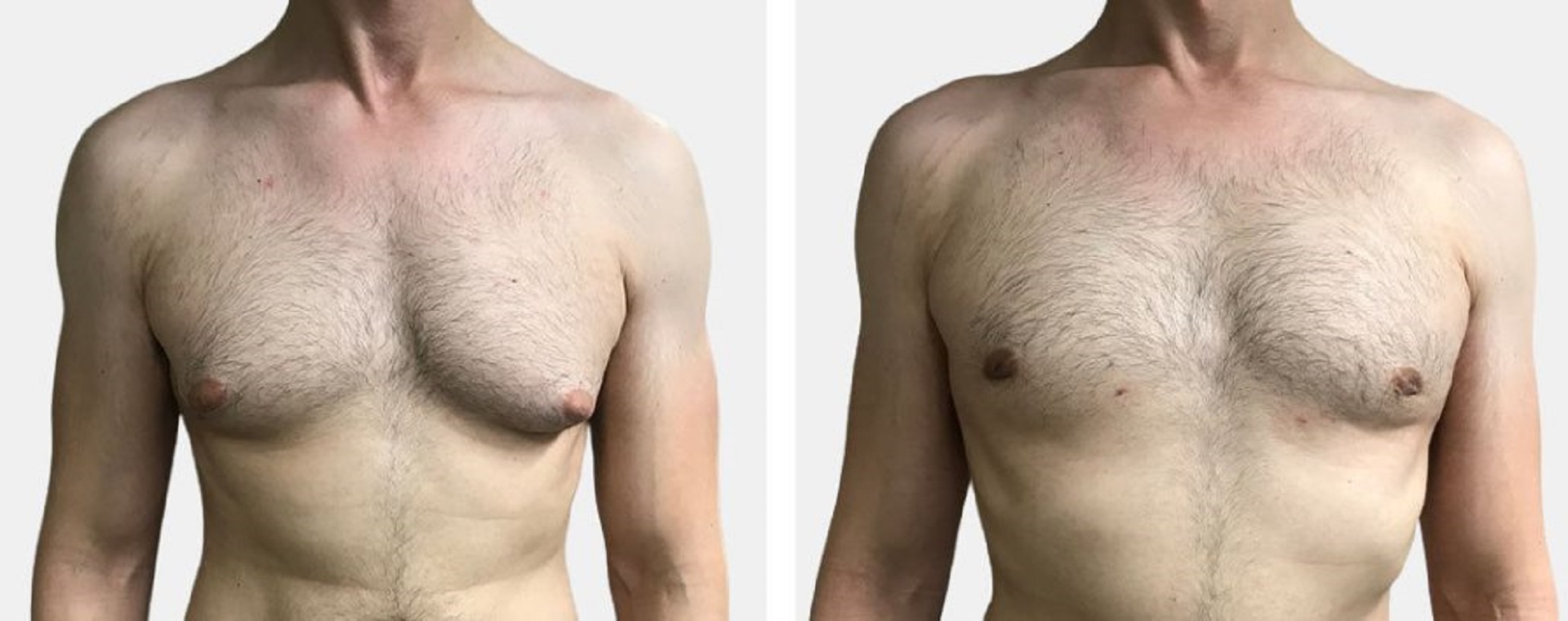 The Role of Ultrasound Technology in Reducing Scarring for Gynecomastia in Dubai