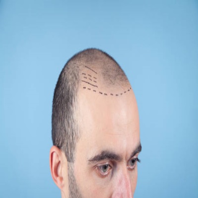  Affordable Hair Transplant Cost in Dubai for 2024