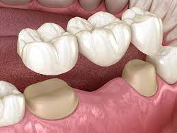  The Top Benefits of Restorative Dentistry in Caldwell ID