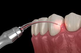  Discover the Benefits of Laser Dentistry in Billings MT: Advanced Dental Care Solutions