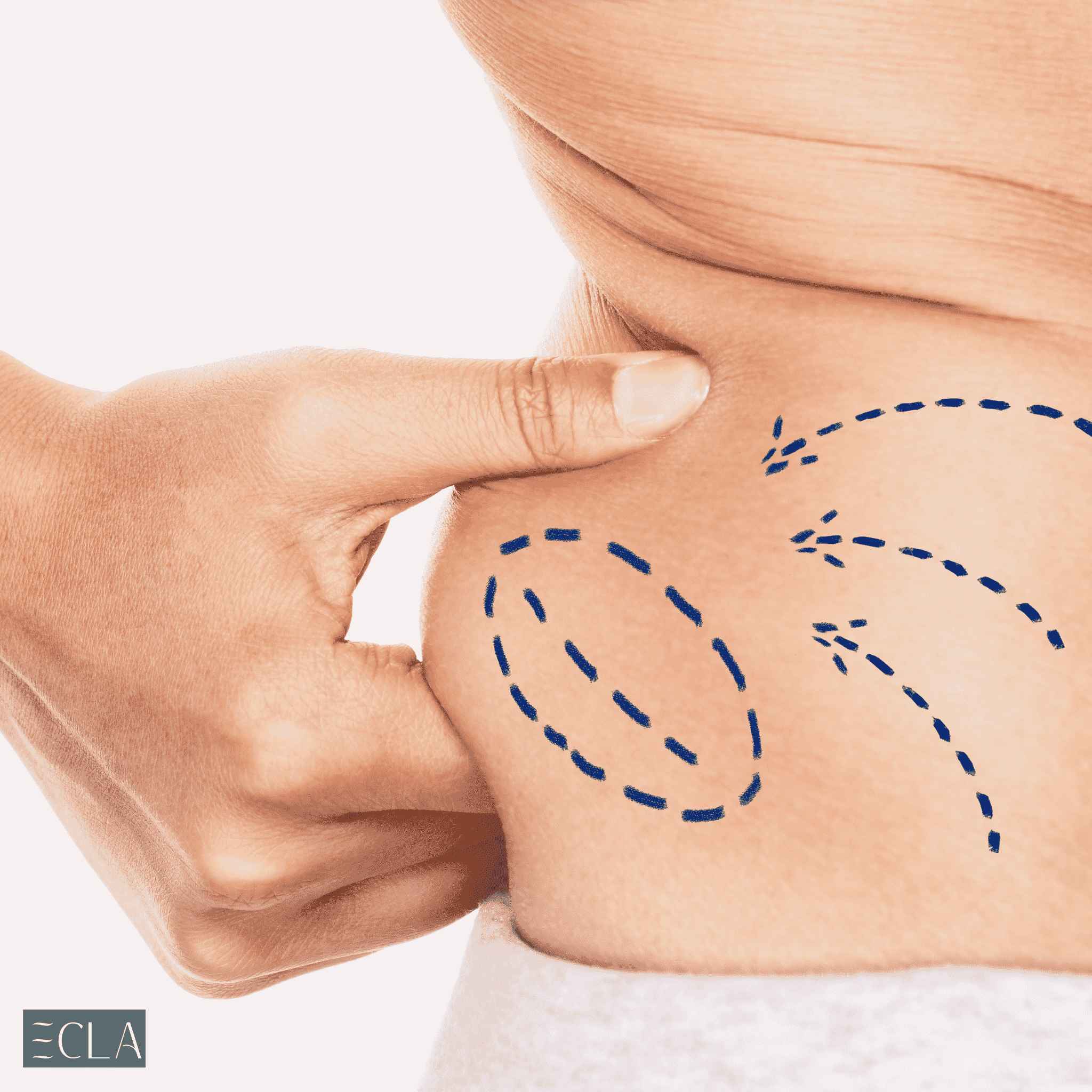 Liposuction in Dubai