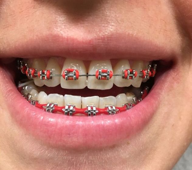  Teeth Braces: Understanding the Basics of Orthodontic Treatment