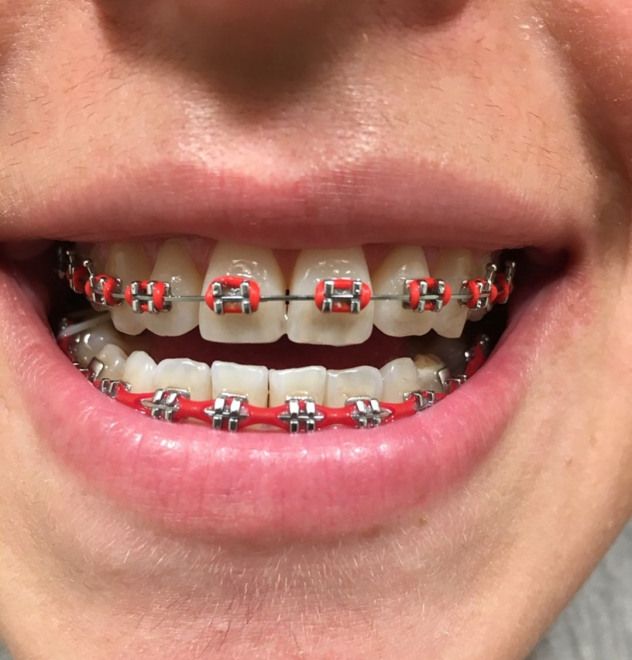 Teeth Braces: Understanding the Basics of Orthodontic Treatment