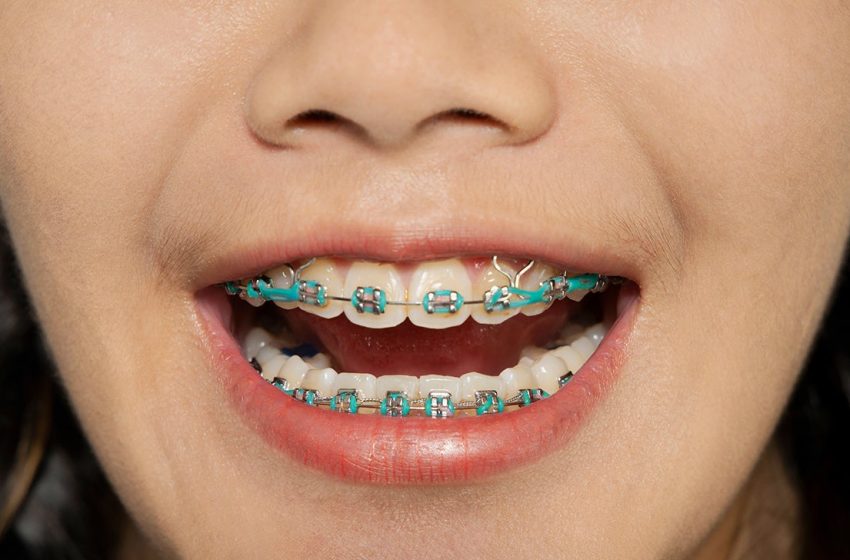  Teeth Braces: Everything You Need to Know