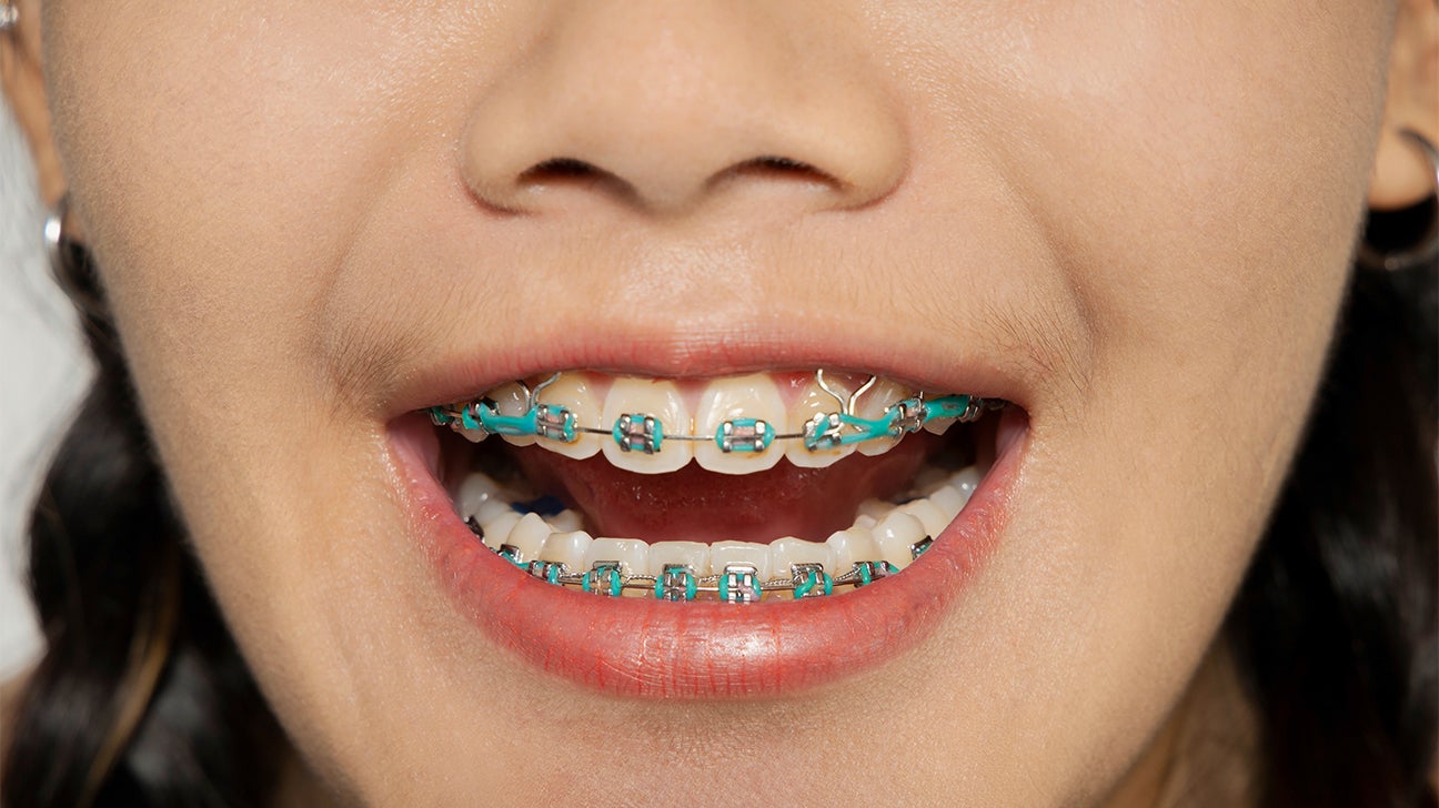 Teeth Braces: Everything You Need to Know