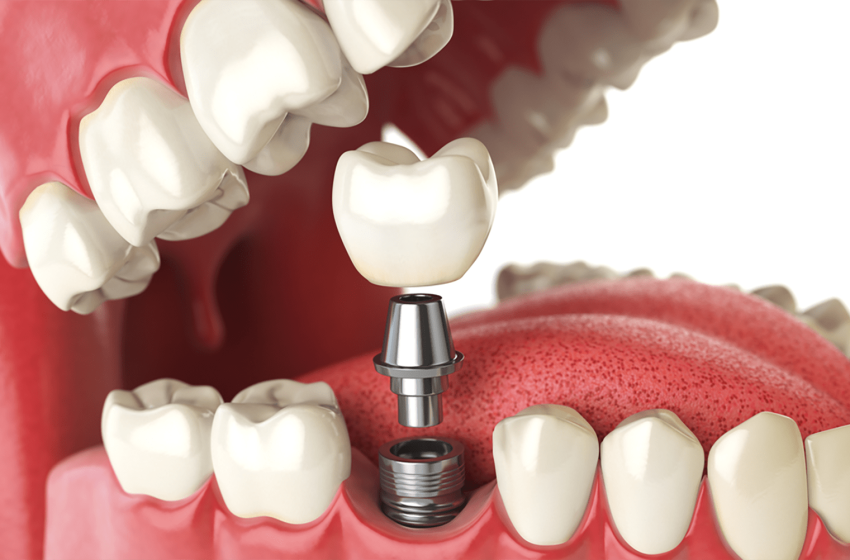  Restoring Functionality: How Dental Implants Improve Quality of Life