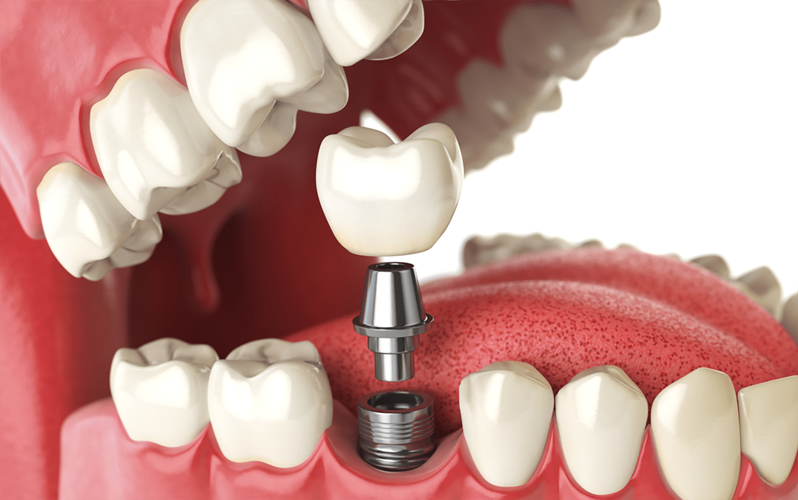 Restoring Functionality: How Dental Implants Improve Quality of Life