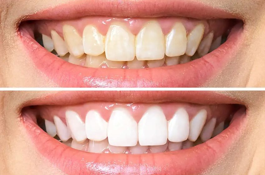  Transform Your Smile with Cosmetic Dentistry in Nampa Idaho