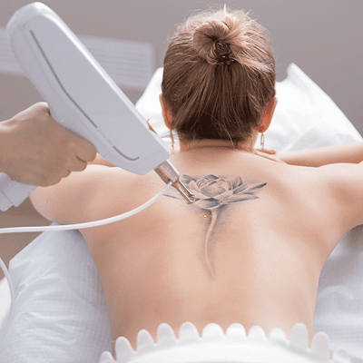 The Evolution of Laser Tattoo Removal Techniques