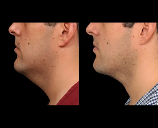 Eyeing Quick Recovery? Solutions from the Best Double Chin Removal Surgeons in Dubai