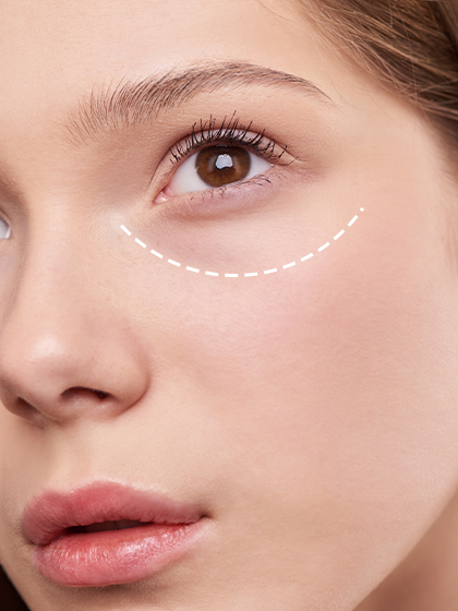  A Complete Guide for How to Remove Dark Circles: Tips, Treatments, and Solutions