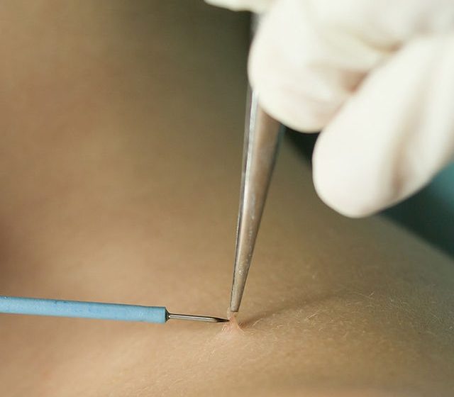  Where to Go for Safe Skin Tag Removal in Dubai?