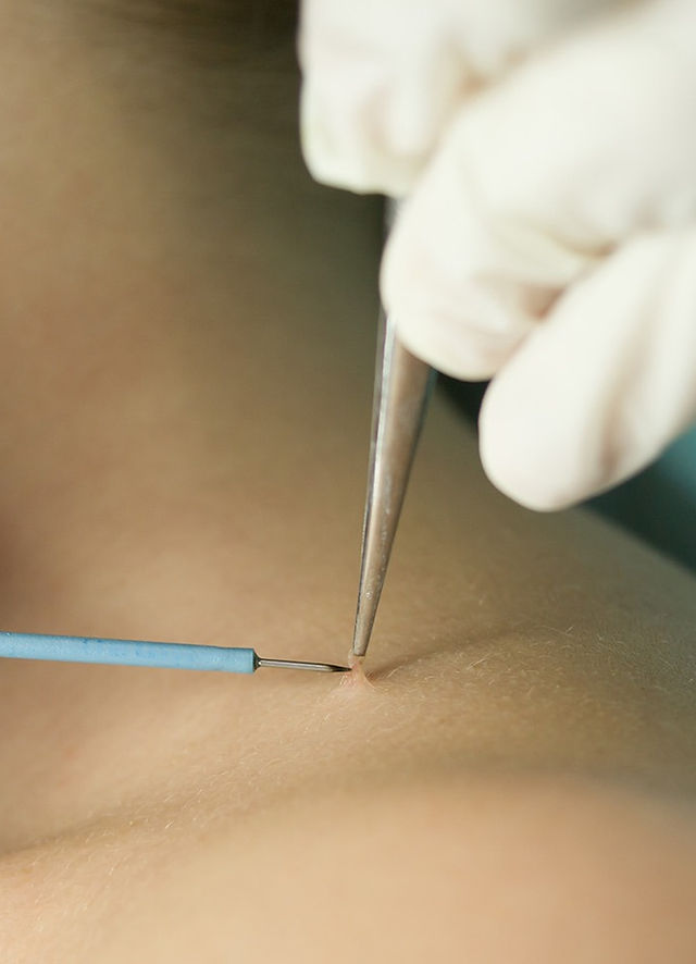 Where to Go for Safe Skin Tag Removal in Dubai?