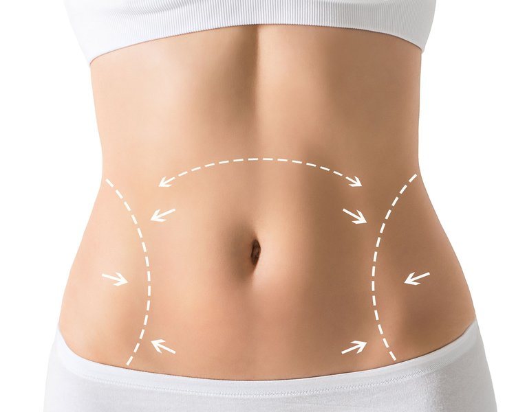 Achieve Your Dream Body : A Comprehensive Look at Tummy Tucks in Dubai