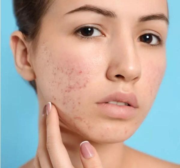  Laser Acne Treatment: What Makes It a Top Choice?