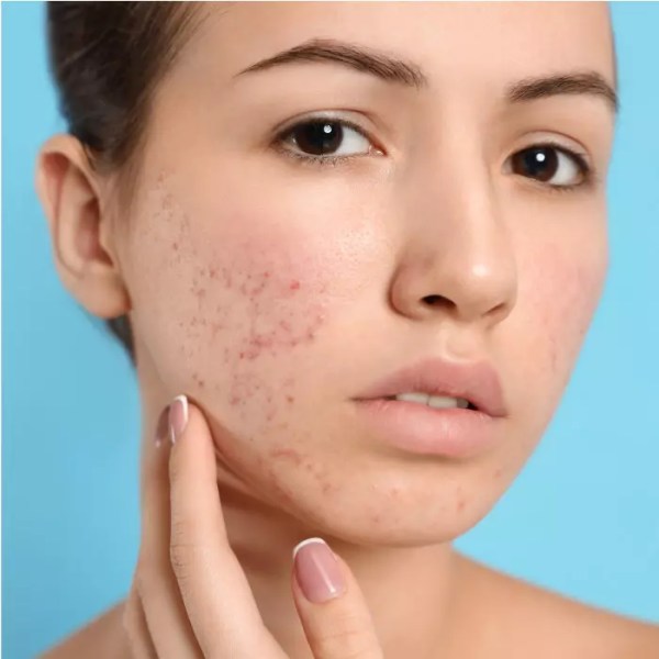 Laser Acne Treatment: What Makes It a Top Choice?