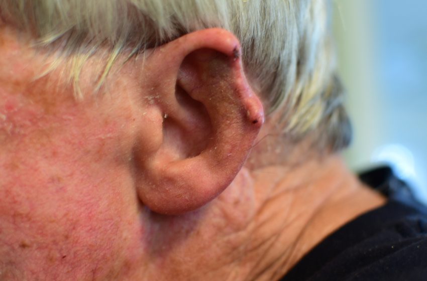  How is skin cancer of the ear treated?