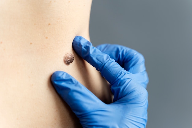  10 Reasons to Consider Professional Mole Removal Services