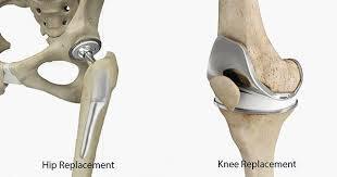  Knee Replacement Surgery in Karachi: Trust Dr. Shohab Hyder Shaikh