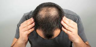 Discover the Best Hair Transplant Clinics in India: Affordable Solutions with QHT Clinic