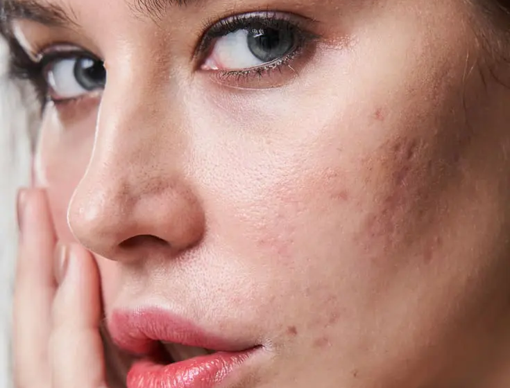  The Impact of Laser Acne Treatment on Your Skin