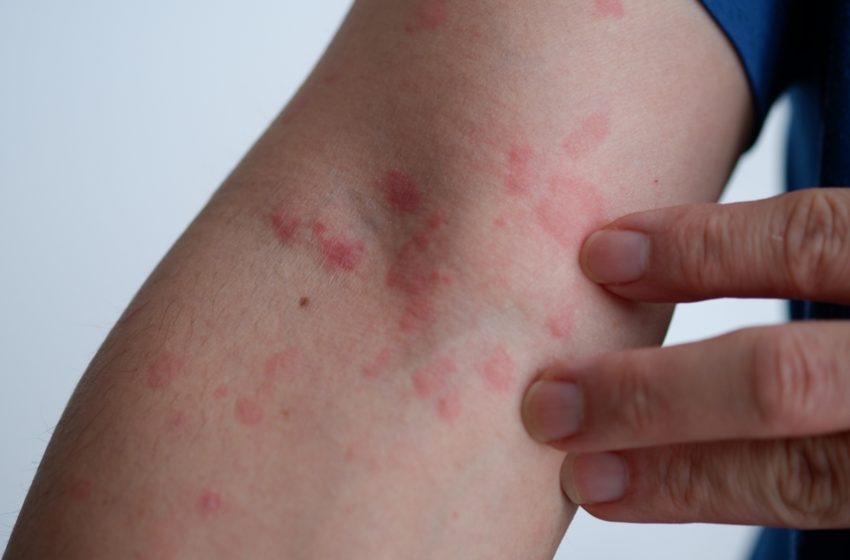  Useful Advice for Preventing Hives Triggers