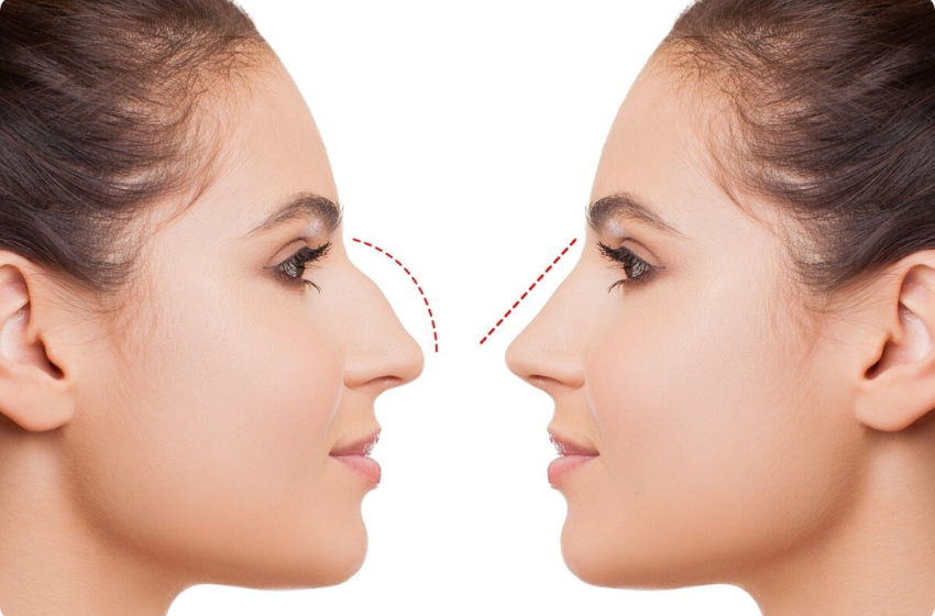  Rhinoplasty in Islamabad: Your 2024 Guide to a Confident Transformation