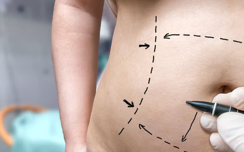  10 Tips for a Smooth Tummy Tuck Recovery