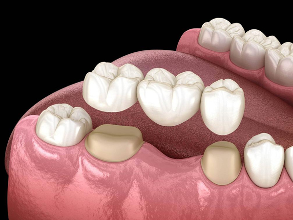  Types of Dental Bridges and Cosmetic Dentistry: Which One is Right for You?