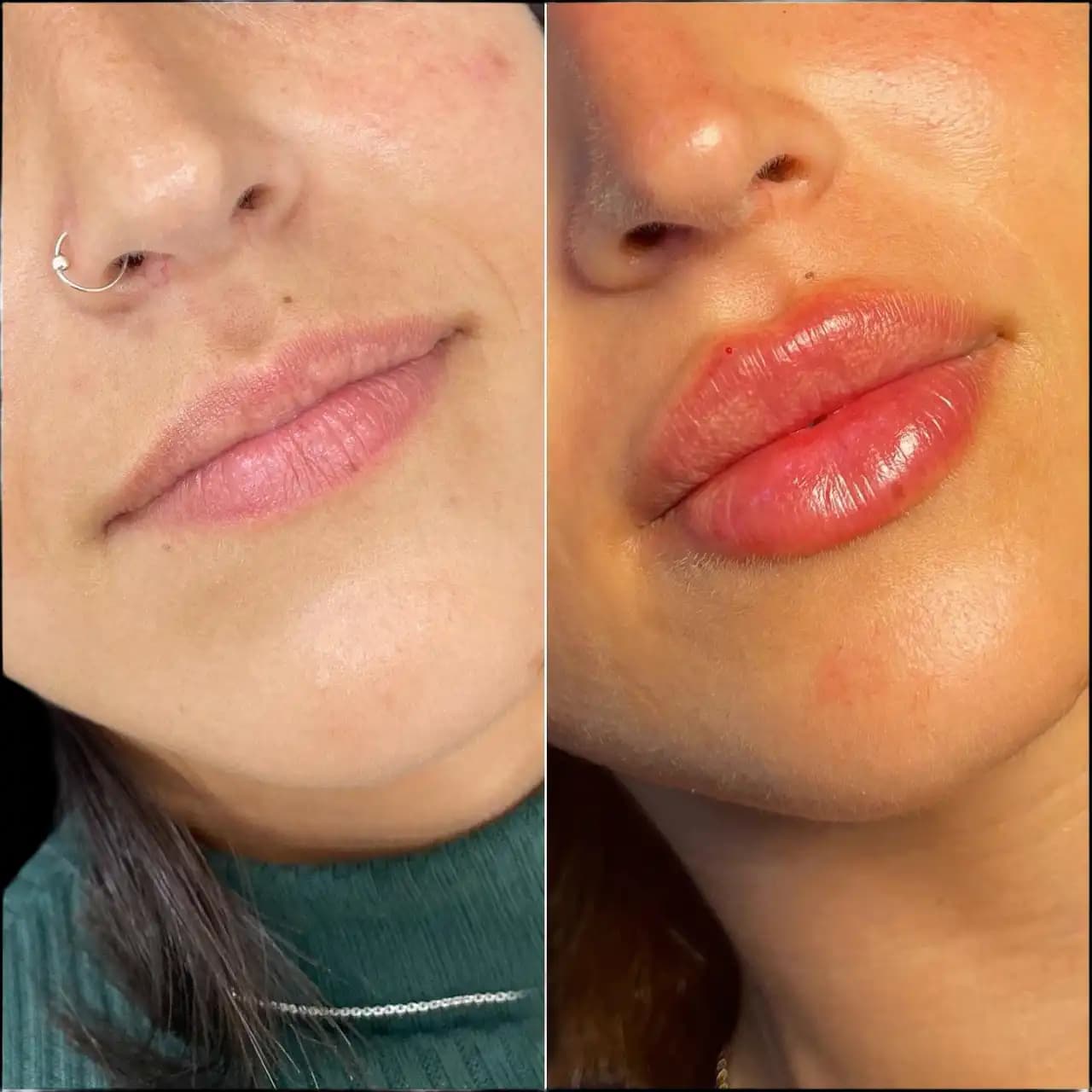 Choosing Lip Fillers Treatments in Dubai Wisely