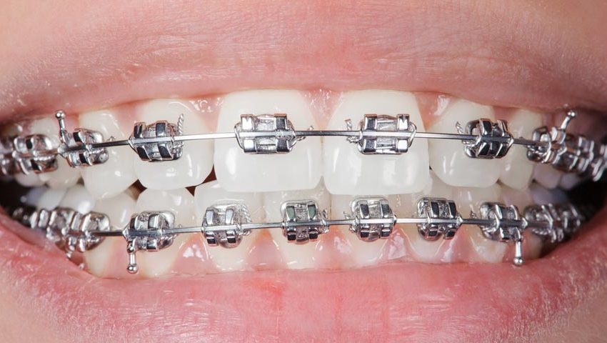  Dubai’s Top Clinics for Teeth Braces: Costs and Benefits