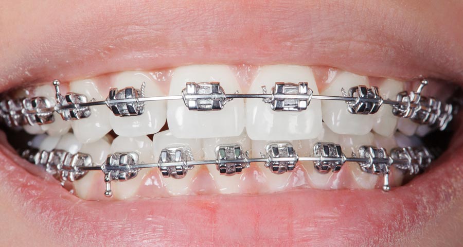 Dubai’s Top Clinics for Teeth Braces: Costs and Benefits