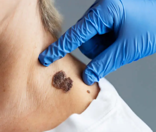  Mole Removal: When to Seek Professional Help