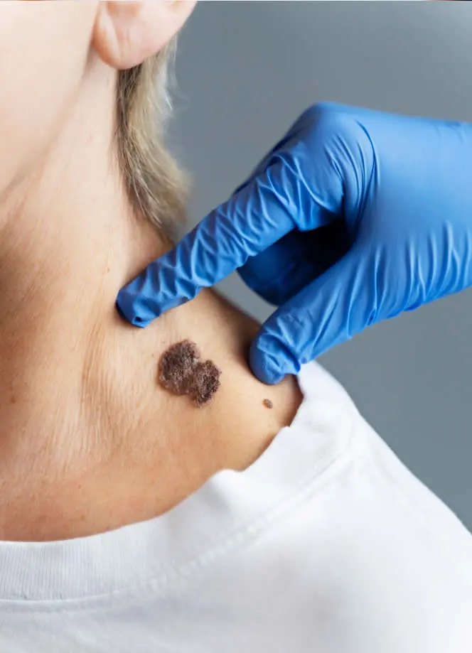 Mole Removal: When to Seek Professional Help