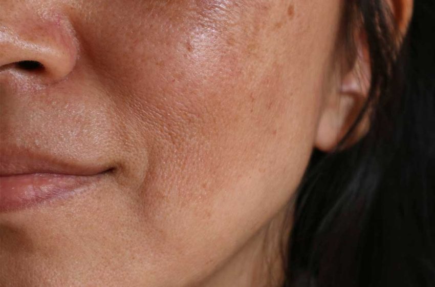  Understanding Melasma: Causes, Treatments, and Preventive Measures