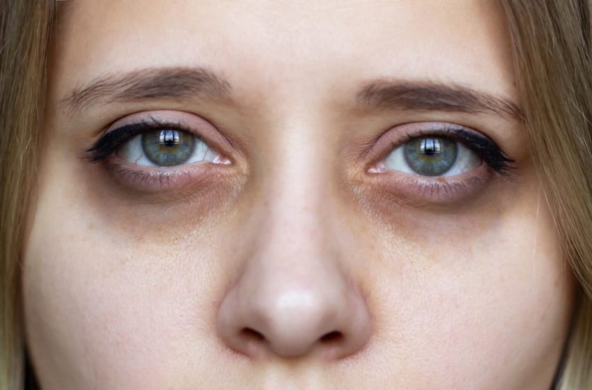  Dark Circles Under The Eyes: Causes & Treatments